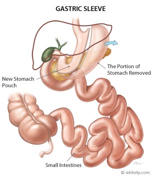 Gastric Sleeve Diagram