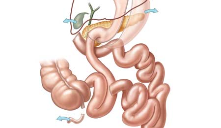 Duodenal Switch