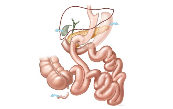 Duodenal Switch Illustration