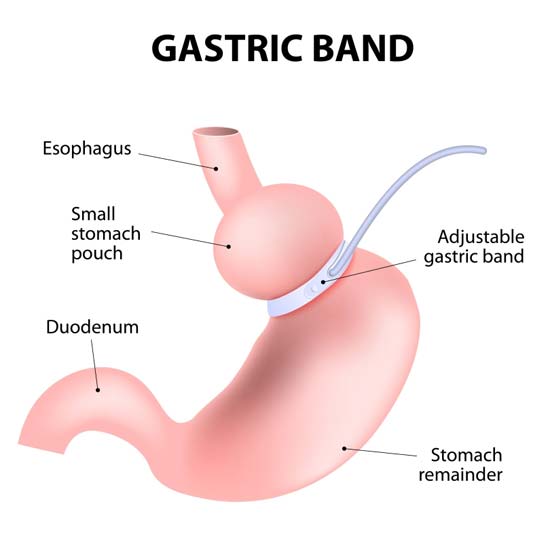 Gastric Band Diagram