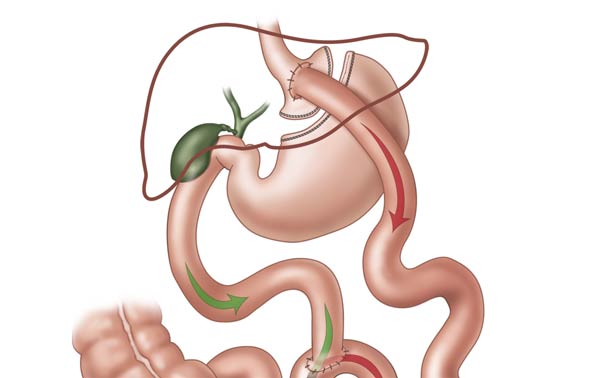 Gastric Bypass Illustration
