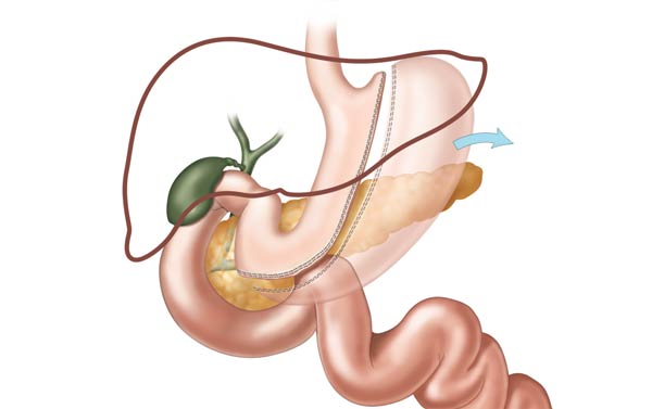 Gastric Sleeve Illustration