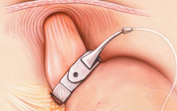 Gastric Band Illustration